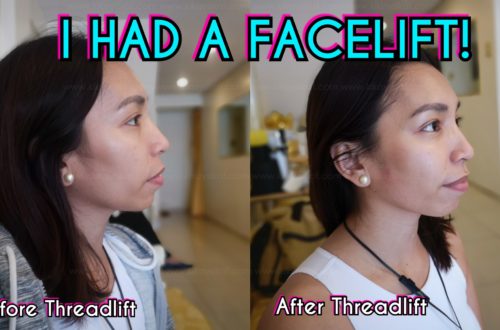 thread-lift-before-after-face-lift-9