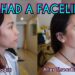 thread-lift-before-after-face-lift-9